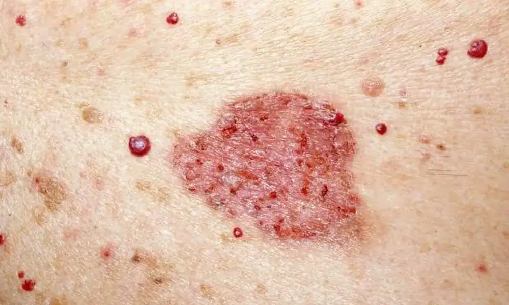 campaña jalisco prevención cáncer de piel