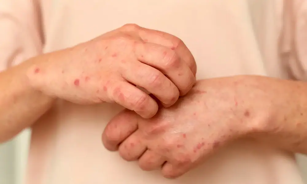 Jalisco suma 421 casos confirmados de sarampión en 2026