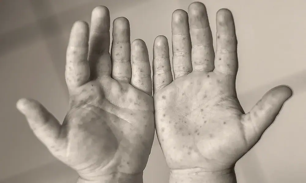 Jalisco reporta segunda muerte por sarampión en 2026