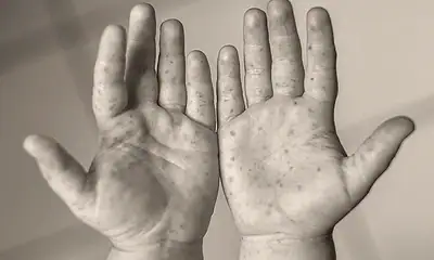 Jalisco reporta segunda muerte por sarampión en 2026