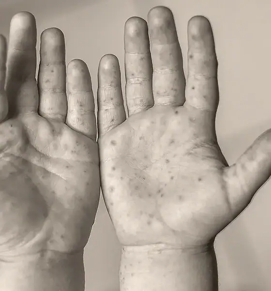 Jalisco reporta segunda muerte por sarampión en 2026