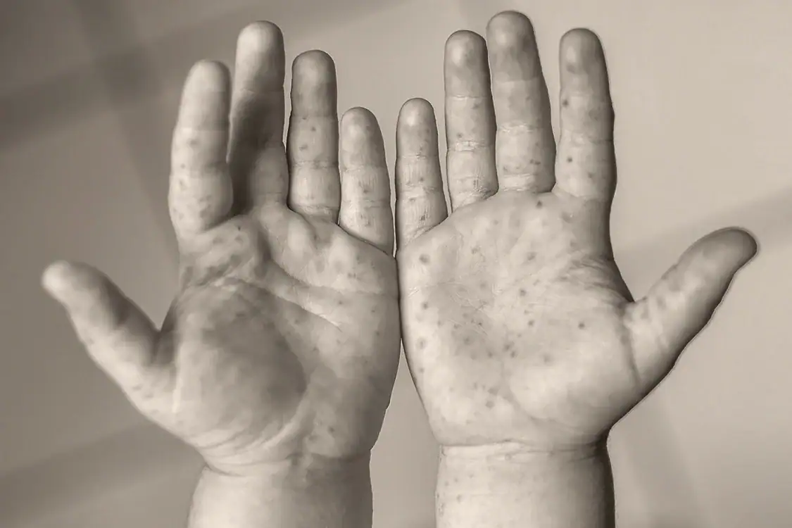 Jalisco reporta segunda muerte por sarampión en 2026